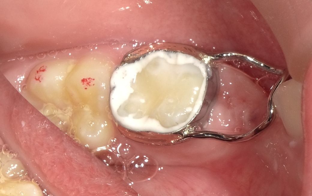 アナトム乳歯冠　歯科 アナトム乳歯冠 歯科 アナトム乳歯冠 歯科