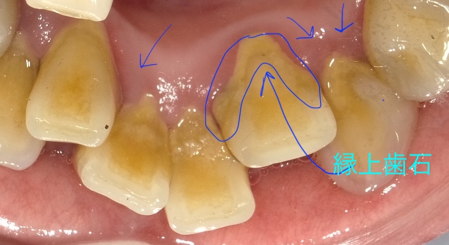 歯石の種類について 縁上（えんじょう）歯石 縁下（えんか）歯石の違い