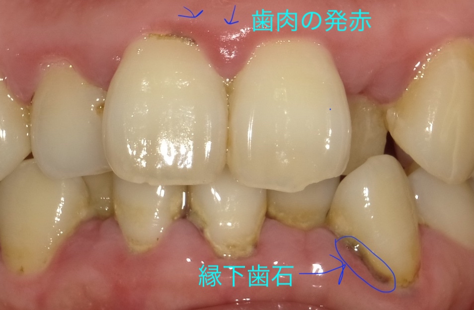 歯石の種類について 縁上（えんじょう）歯石 縁下（えんか）歯石の違い | 名古屋市北区の歯医者｜おくい歯科へ