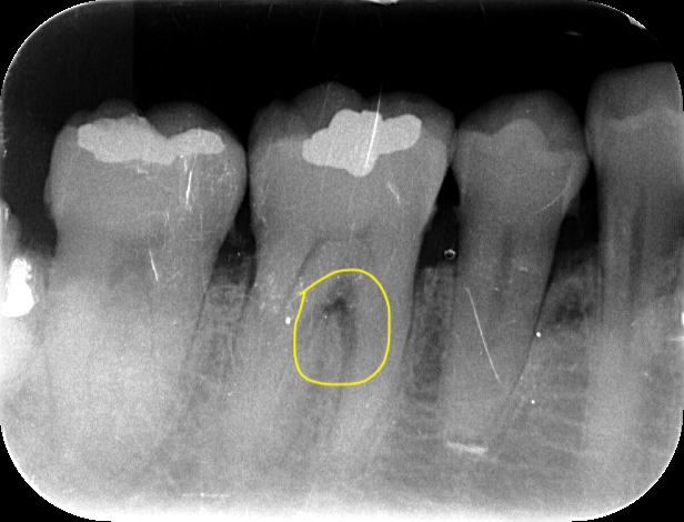 リグロス 歯周組織再生療法について | 名古屋市北区の歯医者｜おくい歯科へ