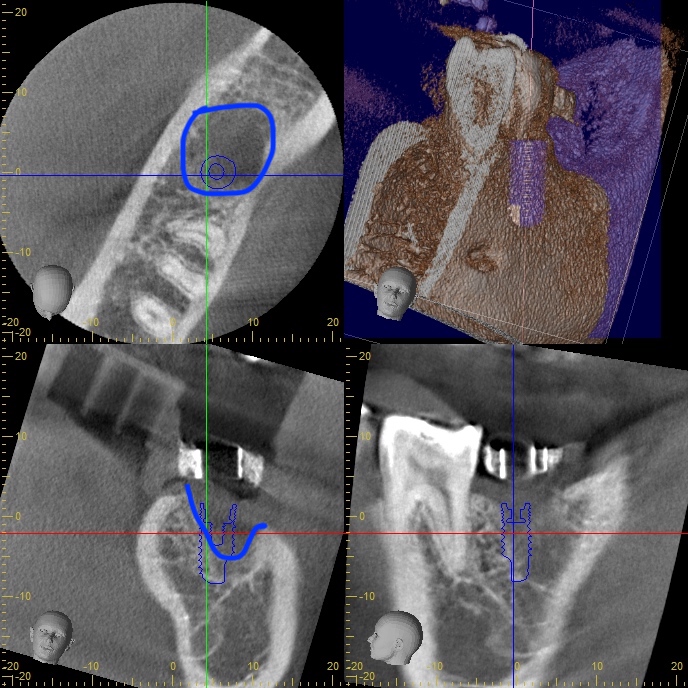 ソケットプリザベーション インプラント骨造成について | 名古屋市北区